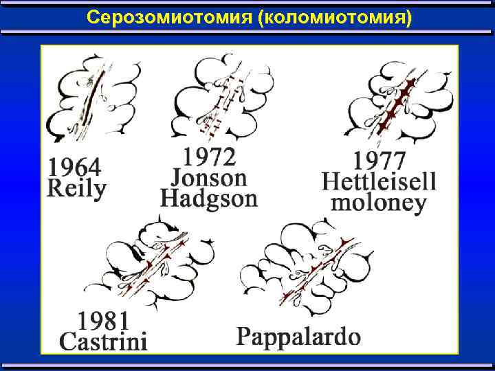 Серозомиотомия (коломиотомия) 