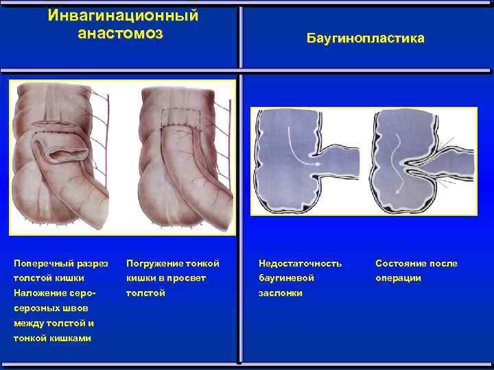 Инвагинационный анастомоз Баугинопластика Поперечный разрез Погружение тонкой Недостаточность Состояние после толстой кишки в просвет