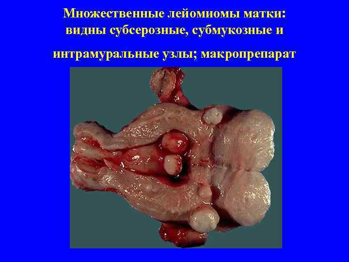 Множественные лейомиомы матки: видны субсерозные, субмукозные и интрамуральные узлы; макропрепарат 