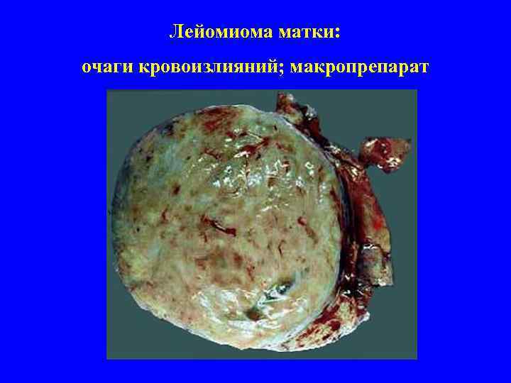Лейомиома матки: очаги кровоизлияний; макропрепарат 