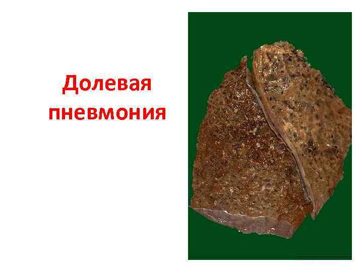 Долевая пневмония 