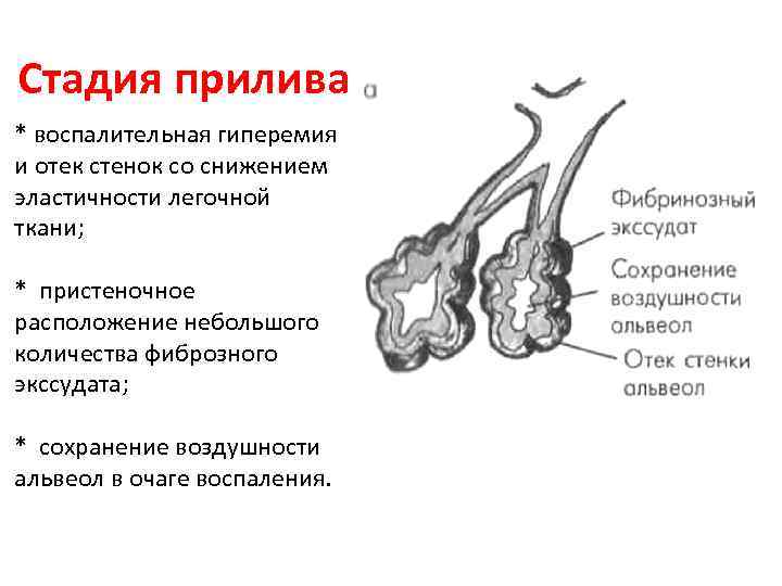 Стадии пневмонии