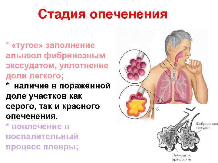 Стадия опеченения * «тугое» заполнение альвеол фибринозным экссудатом, уплотнение доли легкого; * наличие в