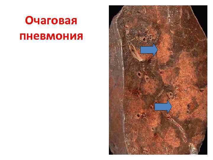 Очаговая пневмония 
