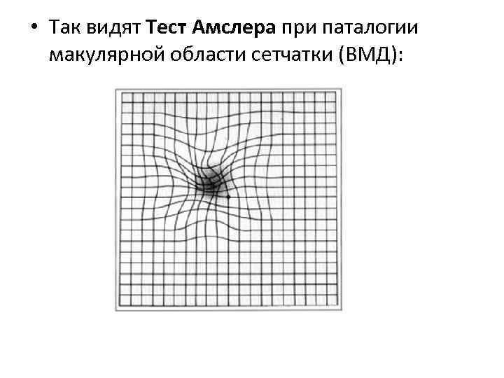  • Так видят Тест Амслера при паталогии макулярной области сетчатки (ВМД): 