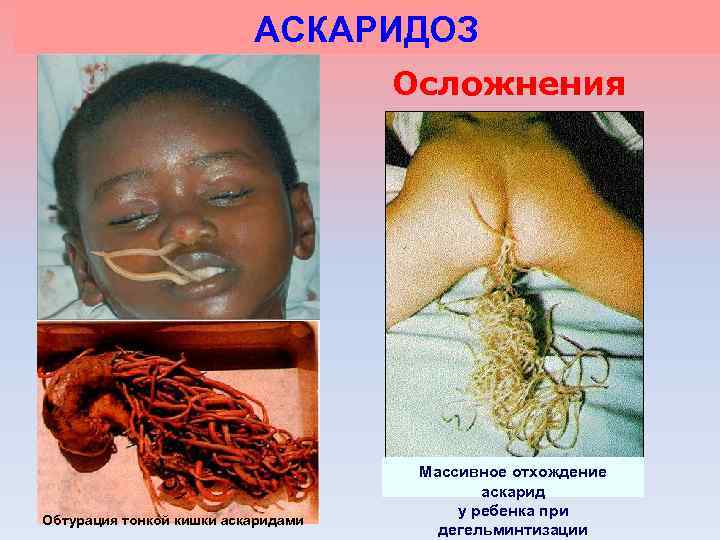 АСКАРИДОЗ Осложнения Обтурация тонкой кишки аскаридами Массивное отхождение аскарид у ребенка при дегельминтизации 