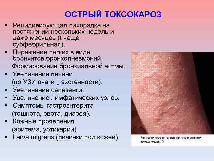 ОСТРЫЙ ТОКСОКАРОЗ • Рецидивирующая лихорадка на протяжении нескольких недель и даже месяцев (t чаще