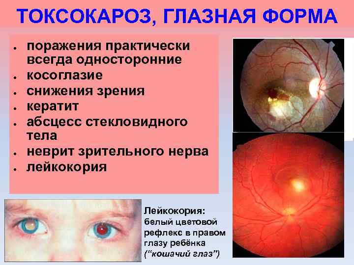 ТОКСОКАРОЗ, ГЛАЗНАЯ ФОРМА поражения практически всегда односторонние косоглазие снижения зрения кератит абсцесс стекловидного тела