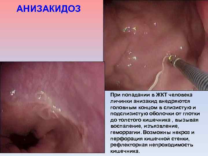 АНИЗАКИДОЗ При попадании в ЖКТ человека личинки анизакид внедряются головным концом в слизистую и