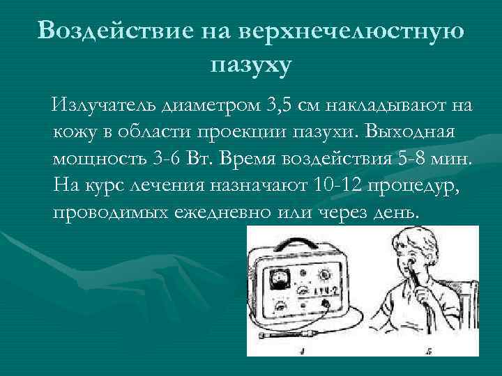 Воздействие на верхнечелюстную пазуху Излучатель диаметром 3, 5 см накладывают на кожу в области