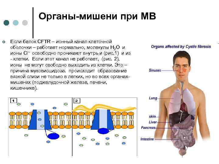 Органы-мишени при МВ ¢ Если белок CFTR – ионный канал клеточной оболочки – работает