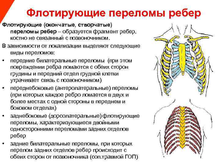  Флотирующие переломы ребер Флотирующие (окончатые, створчатые) переломы ребер – образуется фрагмент ребер, костно