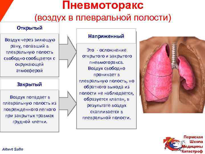  Пневмоторакс (воздух в плевральной полости) Открытый Напряженный Воздух через зияющую рану, попавший в