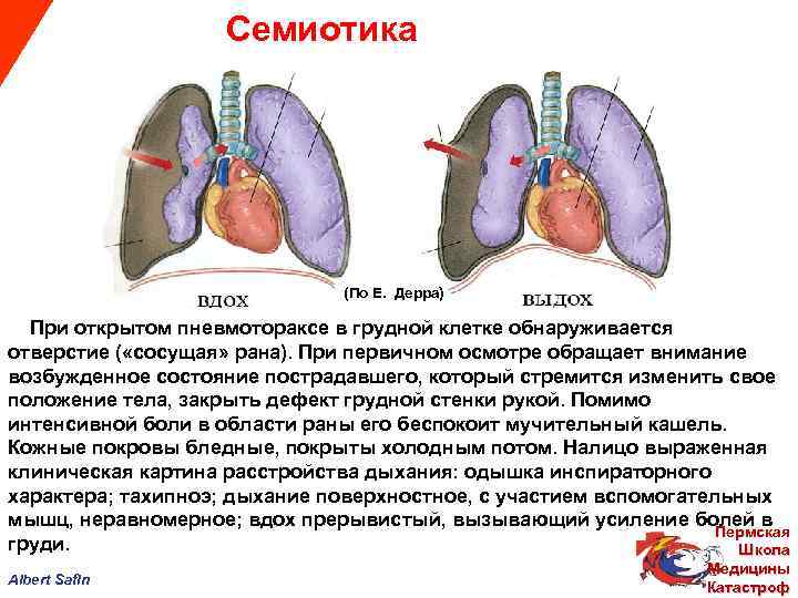  Семиотика (По Е. Дерра) При открытом пневмотораксе в грудной клетке обнаруживается отверстие (