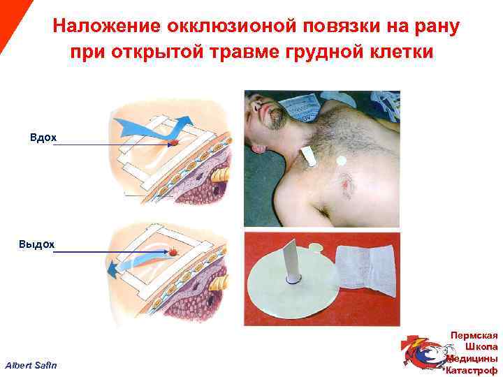  Наложение окклюзионой повязки на рану при открытой травме грудной клетки Вдох Выдох Пермская