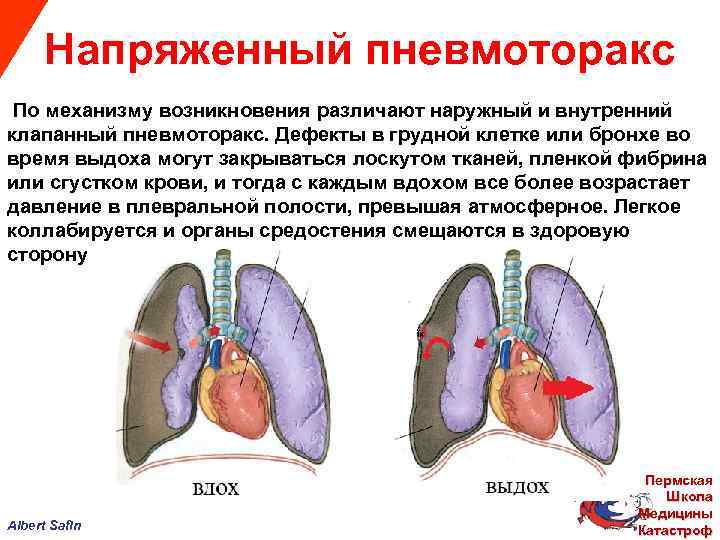  Напряженный пневмоторакс По механизму возникновения различают наружный и внутренний клапанный пневмоторакс. Дефекты в