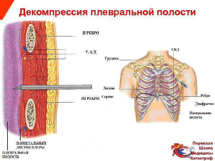  Декомпрессия плевральной полости Пермская Школа Медицины Albert Safin Катастроф 