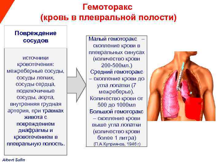  Гемоторакс (кровь в плевральной полости) Повреждение сосудов Малый гемоторакс – скопление крови в