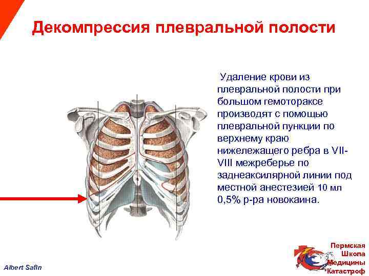  Декомпрессия плевральной полости Удаление крови из плевральной полости при большом гемотораксе производят с