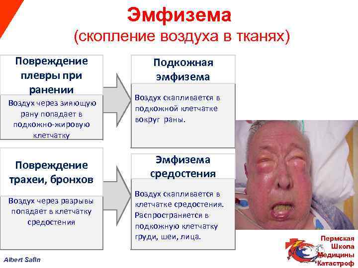  Эмфизема (скопление воздуха в тканях) Повреждение Подкожная плевры при эмфизема ранении Воздух скапливается