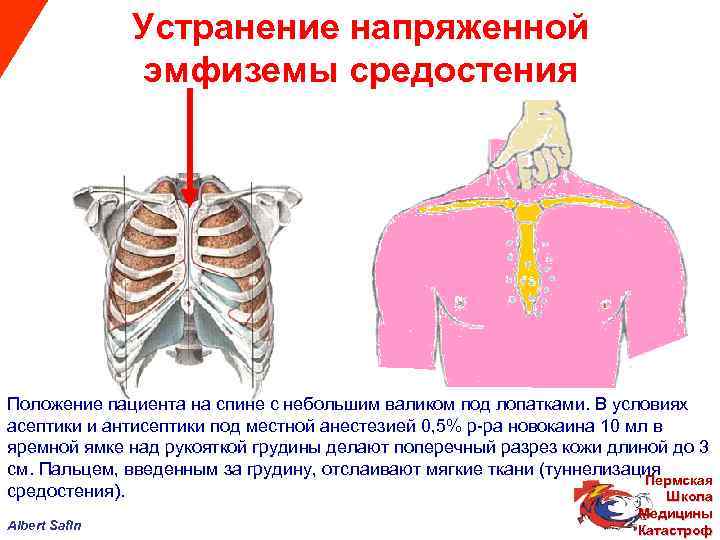  Устранение напряженной эмфиземы средостения Положение пациента на спине с небольшим валиком под лопатками.