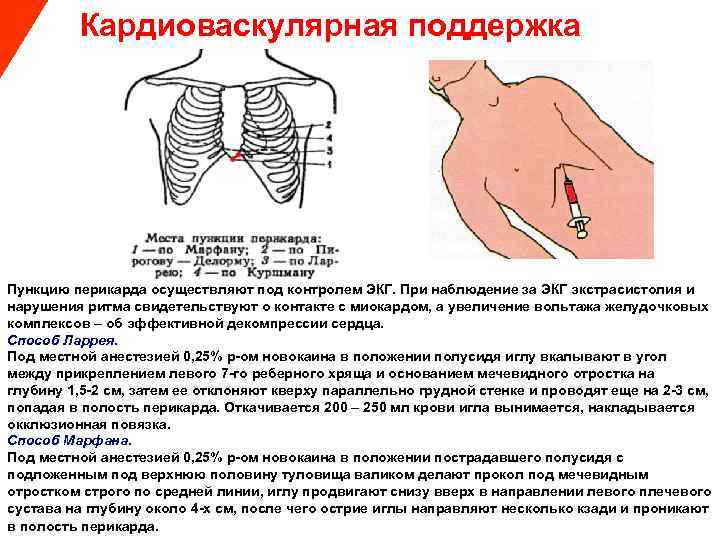  Кардиоваскулярная поддержка Пункцию перикарда осуществляют под контролем ЭКГ. При наблюдение за ЭКГ экстрасистолия