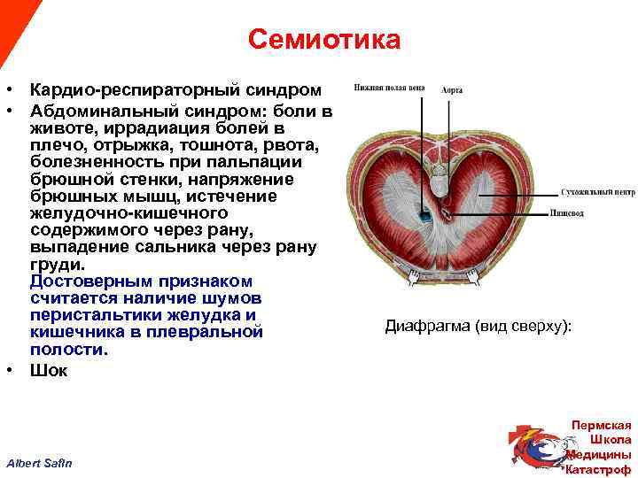  Семиотика • Кардио-респираторный синдром • Абдоминальный синдром: боли в животе, иррадиация болей в