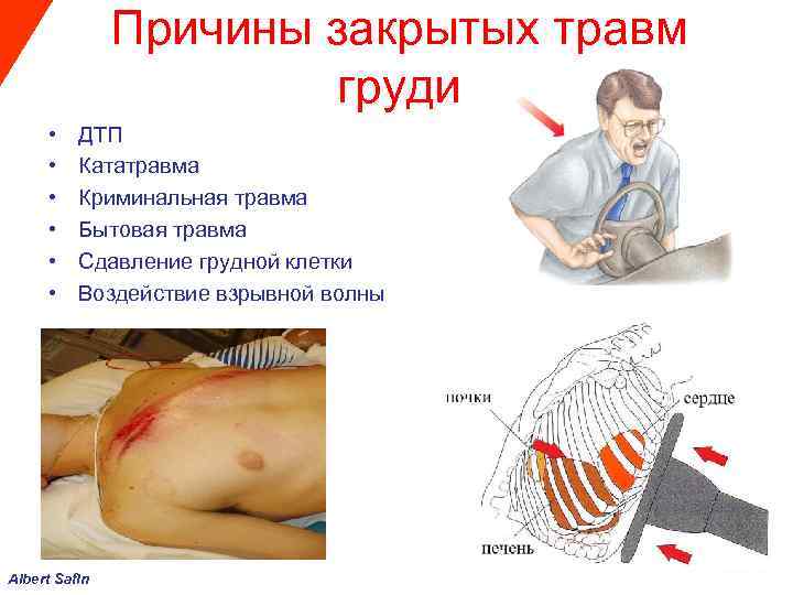  Причины закрытых травм груди • ДТП • Кататравма • Криминальная травма • Бытовая