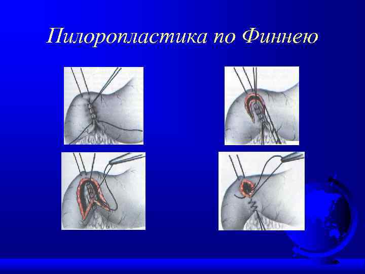 Пилоропластика по Финнею 
