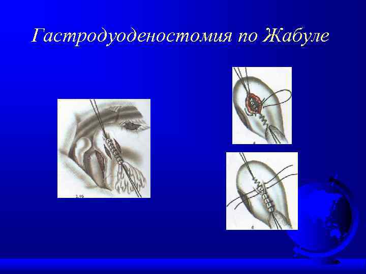 Гастродуоденостомия по Жабуле 