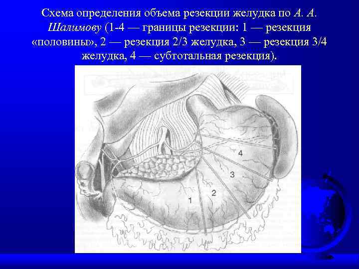 Последствия резекции желудка