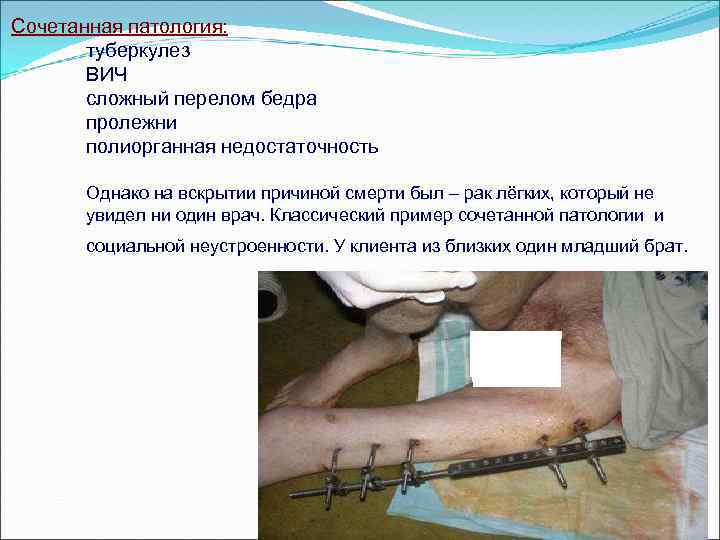 Сочетанная патология: туберкулез ВИЧ сложный перелом бедра пролежни полиорганная недостаточность Однако на вскрытии причиной