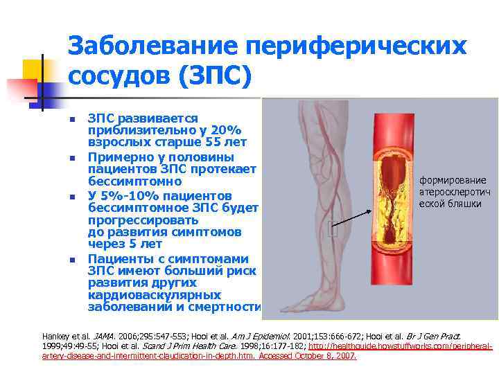 Заболевание периферических сосудов (ЗПС) n n ЗПС развивается приблизительно у 20% взрослых старше 55
