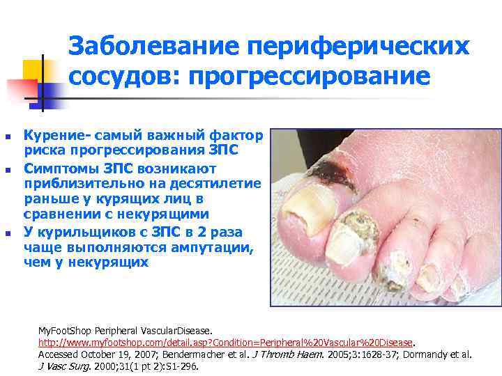 Заболевание периферических сосудов: прогрессирование n n n Курение- самый важный фактор риска прогрессирования ЗПС