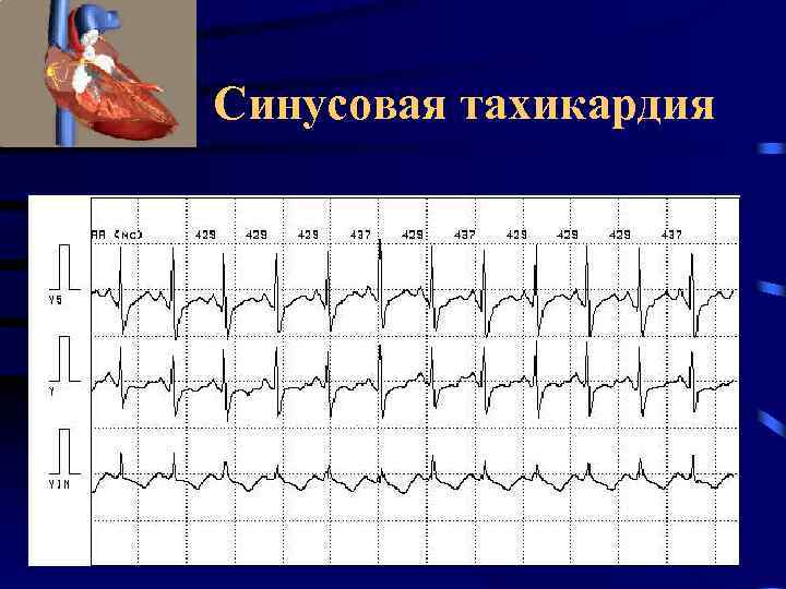 Синусовая тахикардия 