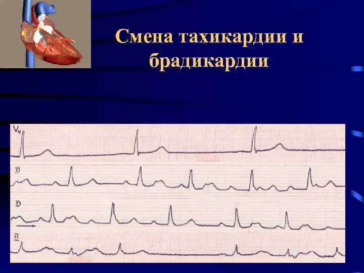 Смена тахикардии и брадикардии 