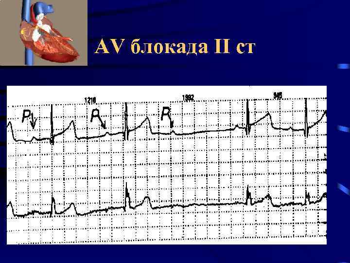 AV блокада II ст 