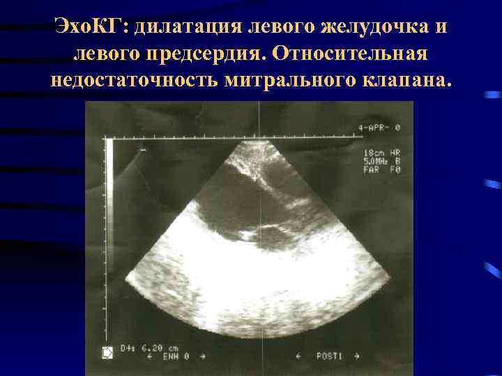 Дилатация левого предсердия. Дилатация левого желудочка ЭХОКГ. Эхокардиография при миокардите. УЗИ дилатация левого желудочка. Дилатация левого желудочка на Эхо.