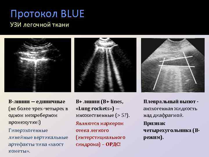 Протокол BLUE УЗИ легочной ткани В-линии ― единичные (не более трех-четырех в одном межреберном