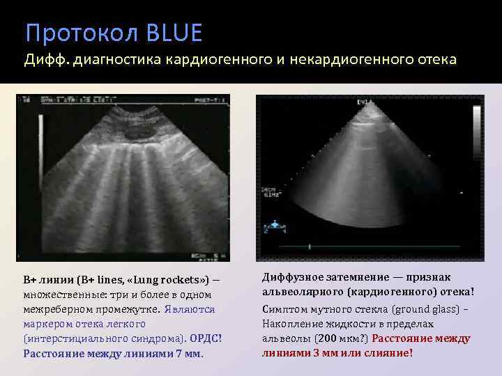 Протокол BLUE Дифф. диагностика кардиогенного и некардиогенного отека В+ линии (В+ lines, «Lung rockets»