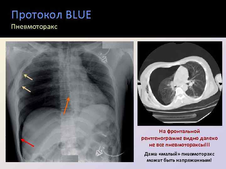 Протокол BLUE Пневмоторакс На фронтальной рентгенограмме видно далеко не все пневмотораксы!!! Даже «малый» пневмоторакс