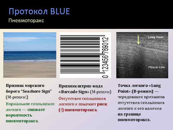 Протокол BLUE Пневмоторакс Признак морского берега “Seashore Sign” (М-режим!) Признак штрих-кода «Barcode Sign» (М-режим)