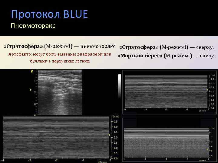 Протокол BLUE Пневмоторакс «Стратосфера» (М-режим!) — пневмоторакс. «Стратосфера» (М-режим!) — сверху. Артефакты могут быть