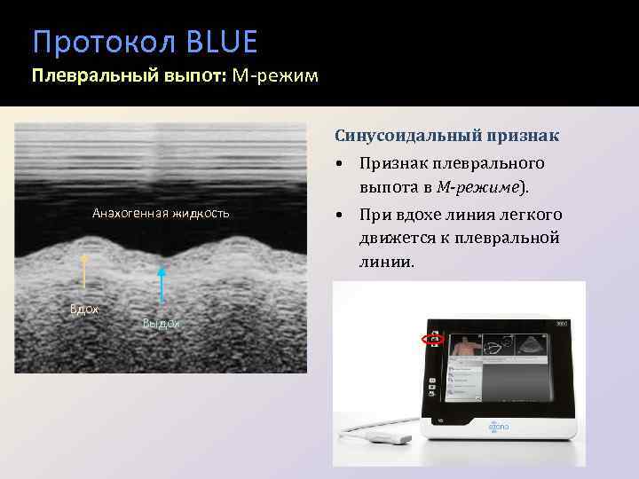 Протокол BLUE Плевральный выпот: M-режим Синусоидальный признак • Признак плеврального выпота в М-режиме). Анэхогенная
