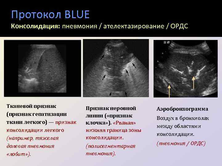 Протокол BLUE Консолидация: пневмония / ателектазирование / ОРДС Тканевой признак (признак гепатизации ткани легкого)
