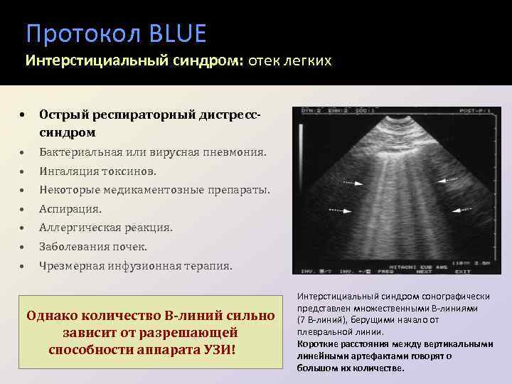 Протокол BLUE Интерстициальный синдром: отек легких • Острый респираторный дистресссиндром • Бактериальная или вирусная
