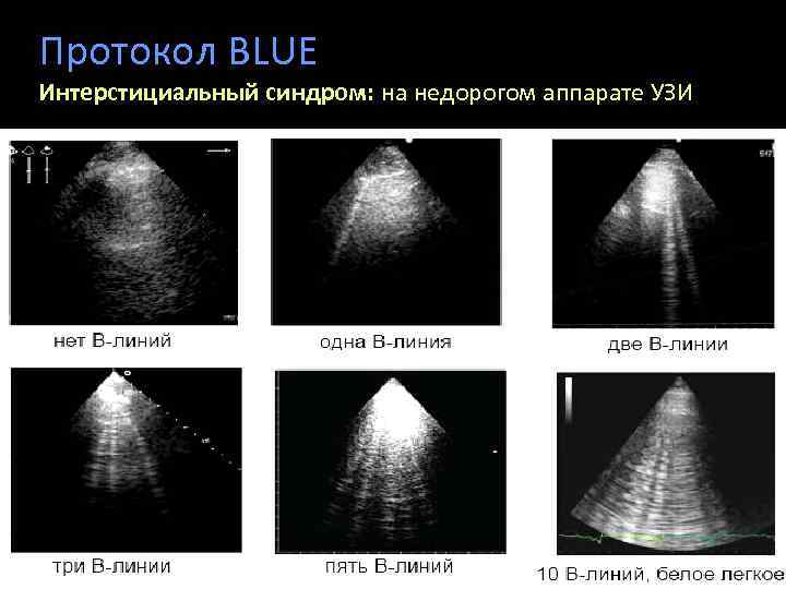 Протокол BLUE Интерстициальный синдром: на недорогом аппарате УЗИ 