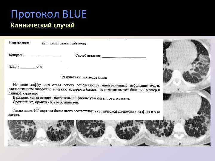 Протокол BLUE Клинический случай 