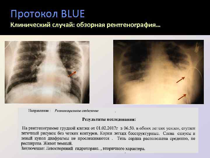 Протокол BLUE Клинический случай: обзорная рентгенография… 