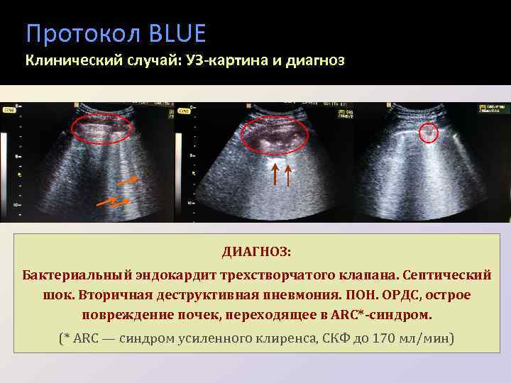 Протокол BLUE Клинический случай: УЗ-картина и диагноз • Признаки ОРДС, множественные двухсторонние консолидации! ДИАГНОЗ: